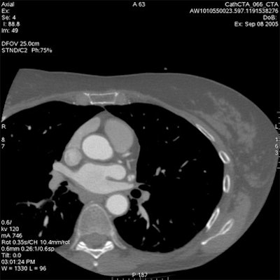 Medium 25-cm FOV coronary CTA image