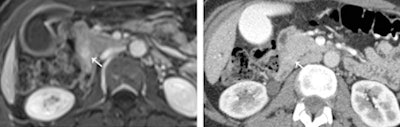 An ampullary carcinoma is seen with contrast with contrast-enhanced T1-weighted MRI (left), but is not visible on contrast-enhanced CT (right)