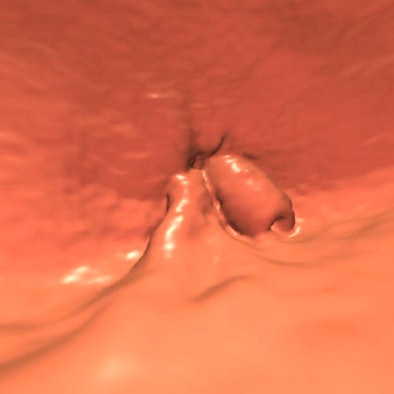 2011 06 08 16 13 28 205 Pooler colo cancer 65yo