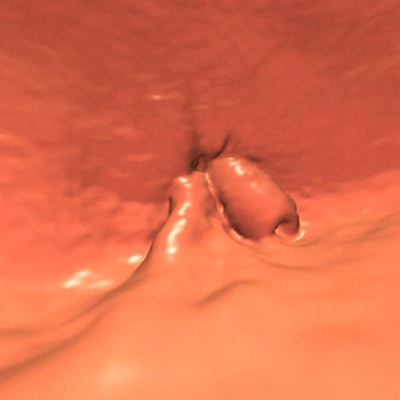 2011 06 08 16 13 28 205 Pooler colo cancer 65yo