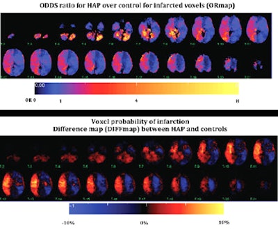 A recent MGH study found a significant correlation between right insula infarct and the development of hospital-acquired pneumonia.
