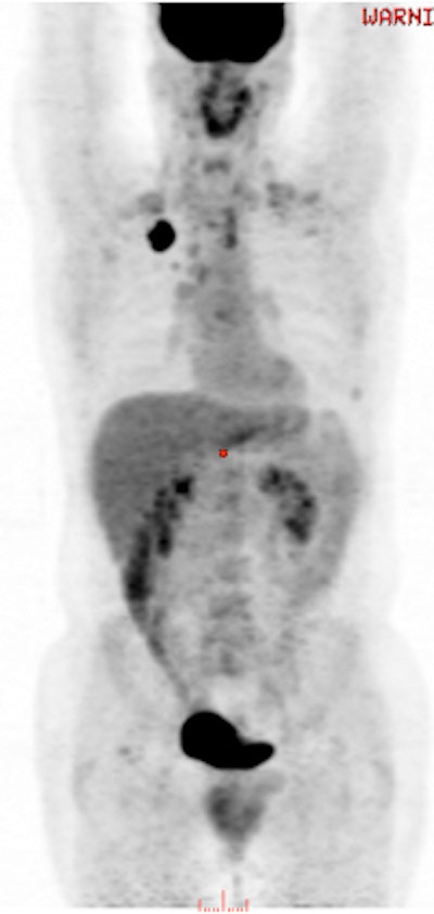 A 49-year-old male with non-small cell lung cancer received an FDG-PET scan three hours and 45 minutes after a treadmill stress test. The image reveals no conspicuous muscle uptake. SUVmax was 1.2 and SUVmean was 0.7. Image courtesy of Dr. Ashima Lyall.