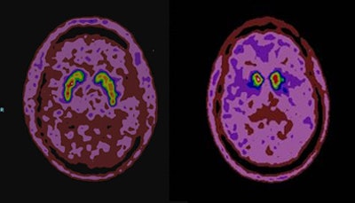 F-18 DOPA-PET images of a patient without Parkinson's disease and a patient with the disease