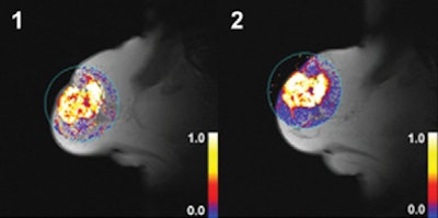 MR of grade 2 carcinoma