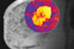 2011 07 06 16 04 57 96 Li Mri Breast Thumb