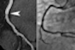 2011 07 26 13 20 06 780 Ho Stent Highpitch 70