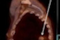 2011 08 05 10 31 37 792 Spect Nsclc Md Anderson Thumb