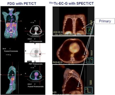 Tc-99m ECG versus FDG