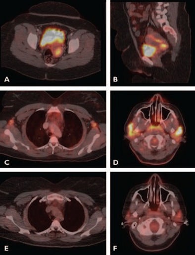 PET/CT of HIV-positive woman