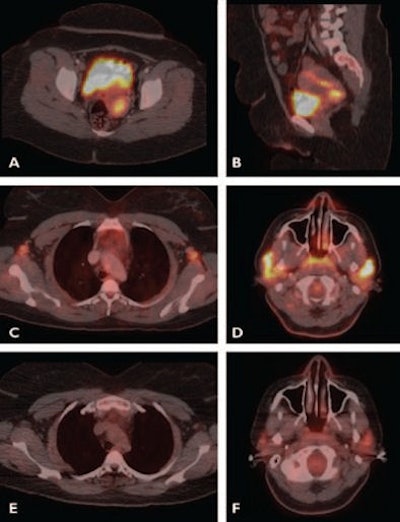 PET/CT of HIV-positive woman