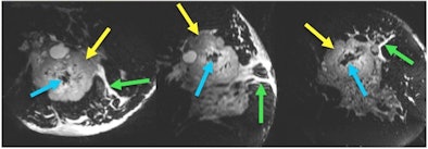 18-channel prototype coil