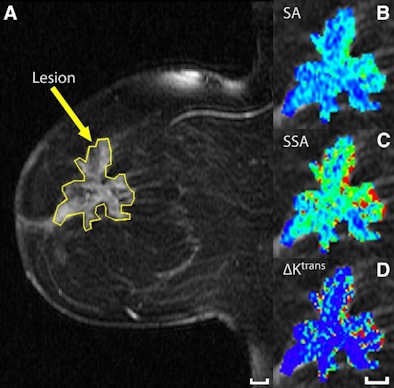 MR image of a 57-year-old woman with invasive lobular carcinoma