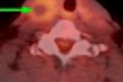 2011 08 26 12 06 22 179 2011 08 29 Jugular Vein Occlusion Thumb