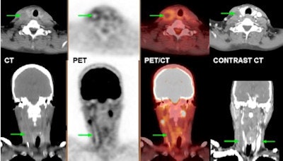 A 57-year-old-woman with fully occluded left internal jugular vein