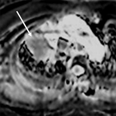 2011 08 31 13 33 47 275 2011 08 31 Adc Mri Before