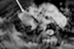 2011 08 31 13 33 47 508 2011 08 31 Adc Mri Thumb