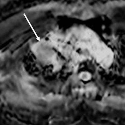 2011 08 31 13 33 48 128 2011 08 31 Adc Mri After