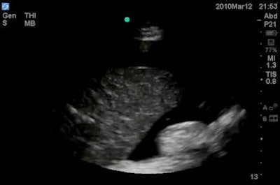 Ultrasound revealed a ruptured splenic artery aneurysm