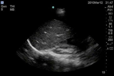 A 26-year-old woman with upper abdominal pain, chest pain, and no history of trauma. She presented to the ED with hypotension after watching a golf game and required CPR shortly after triage in the ED. First impression was ruptured ectopic pregnancy versus pulmonary embolism, but ultrasound revealed a ruptured splenic artery aneurysm. Images courtesy of Dr. Hamid Shokoohi.