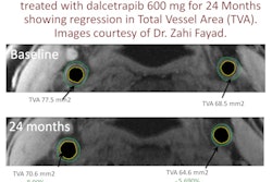 2011 09 13 15 44 21 809 Dalcetrapib 450
