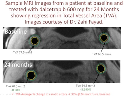 Regression in total vessel area with dalcetrapib