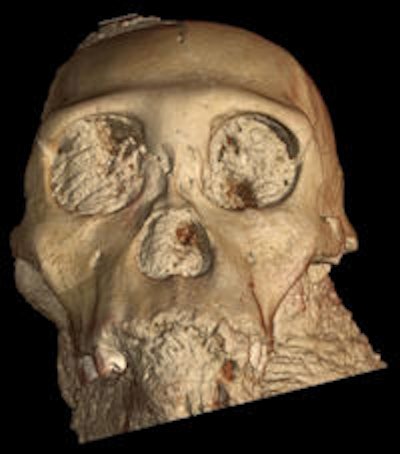 3D rendering of the skull of Australopithecus sediba from x-ray data gathered at the ESRF. Image courtesy of ESRF and Paul Tafforeau, PhD.