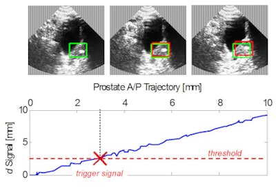 In-plane prostate displacement. The lower image demonstrates the activation of a trigger signal.