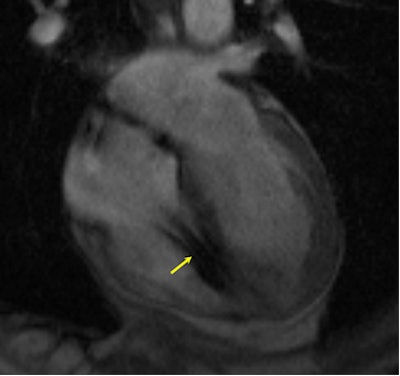 Heart with a defibrillator lead in the right ventricle