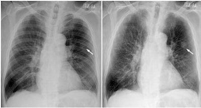 Chest Posteroanterior Radiographs In 79 Year Old Man With Nodular Cancer Image At Left Is Standard X Ray; Image At Right Is Bone Suppression