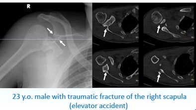 A 23-year-old man presented with a dramatic fracture of the right scapula from an elevator accident