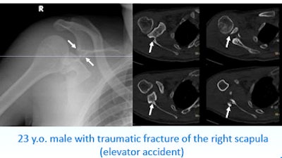 A 23-year-old man presented with a dramatic fracture of the right scapula from an elevator accident
