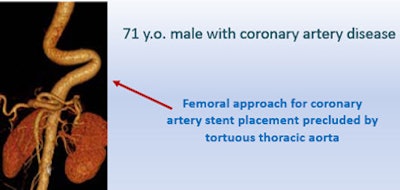 Treatment of a 71-year-old man with coronary artery disease was complicated by the patient's tortuous thoracic aorta