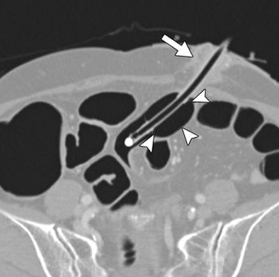 Woman, 72, who had a sigmoid colostomy undergoes CTC