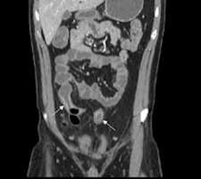 Patient with active ileocolonic Crohn's disease