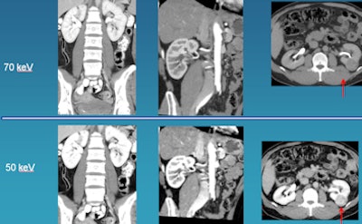 Low-kV imaging improves contrast enhancement