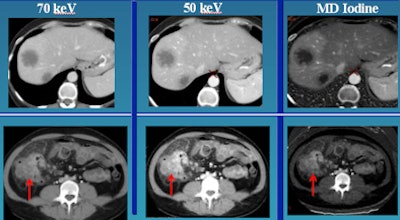In liver perfusion abnormality, differential enhancement is better seen on material differentiation iodine image
