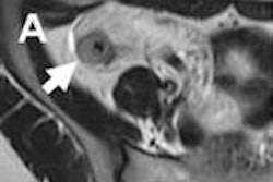 MR enterography detection of active inflammation and fibrosis