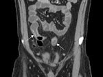 Patient with active ileocolonic Crohn's disease