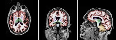 Volumetric Mri Using Neuro Quant