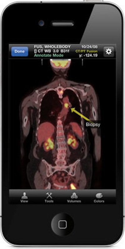 The FDA in 2011 cleared Mobile MIM, the first app for reviewing medical images on iPhone and iPad devices. Image courtesy of MIM Software.