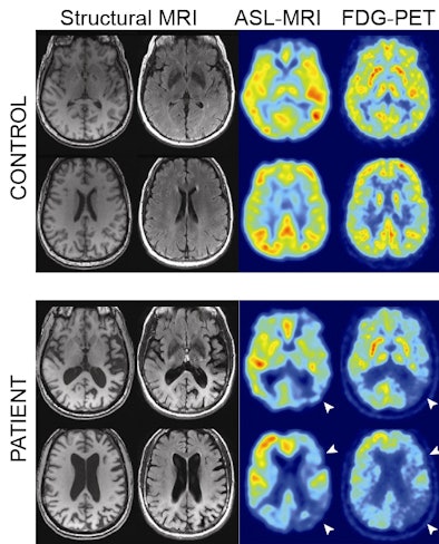 Structural Mri, Asl Mri, And Fdg Pet Images From Control Subjects And Alzheimer's Disease Patients