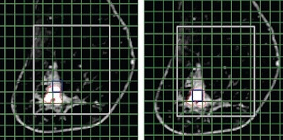 Mr Images Of Invasive Ductal Carcinoma In A 62 Year Old Woman