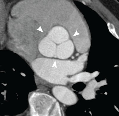 Normal Aortic Root At Coronary Cta Illustrating The Complex Cornet Shape Above The Basal Ring