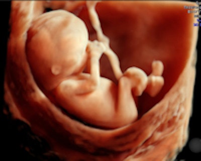A 3D fetal image acquired with GE's Voluson scanner.