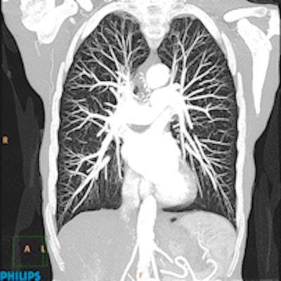 Ingenuity CT chest image processed with Philips' iDose4 iterative reconstruction algorithm at level 3 setting. Imaging parameters are 80 kVp, 91 mAs/slice, 32-cm coverage, 6.0-sec scan time, 1.7 mGy CTDIvol, 66.5 DLP (mGy-cm), and 0.9 mSv radiation dose.