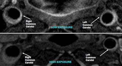 No Significant Plaque Burden Appears In Sample Carotid Images From Patients With Low And High Particulate Matter Exposure
