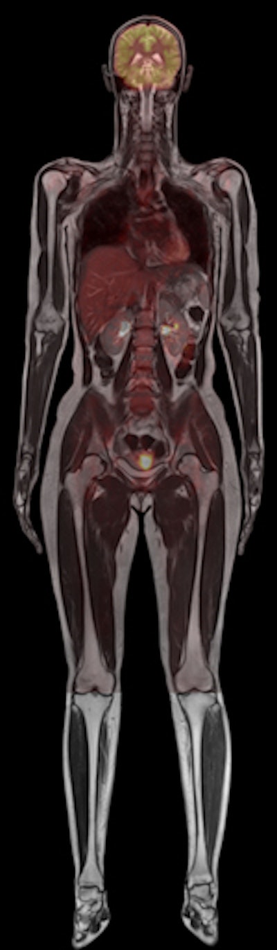 Whole-body image obtained with Biograph mMR PET/MR system. Image courtesy of Siemens.