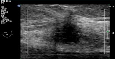 Abus Showed A Small Mass In The Left Breast