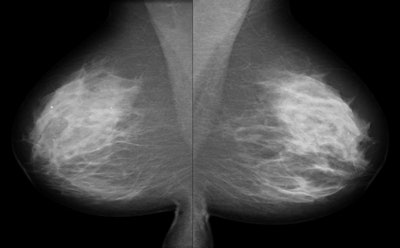 Mlo Views Of A 56 Year Old Woman Are Normal