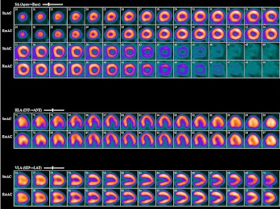 With The Help Of Cardio Gen 82, Mild Degrees Of Ischemia Are Discovered Through Pet Imaging